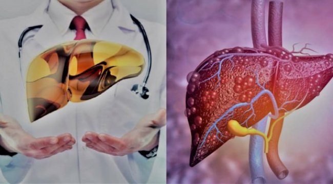 Karaciğer Yağlanması bulguları, nebatsal rehabilitasyon: Arınan gıdalar?