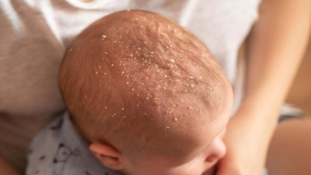 Bebeklerde konak neden olur? Belirtileri ve tedavi teknikleri