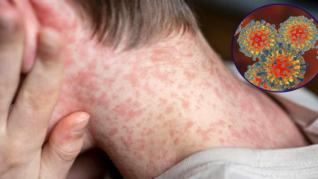 Dünyanın en bulaşıcı hastalığı geri döndü: Kızamık krizi 10 bireyden 9’unu yakalıyor