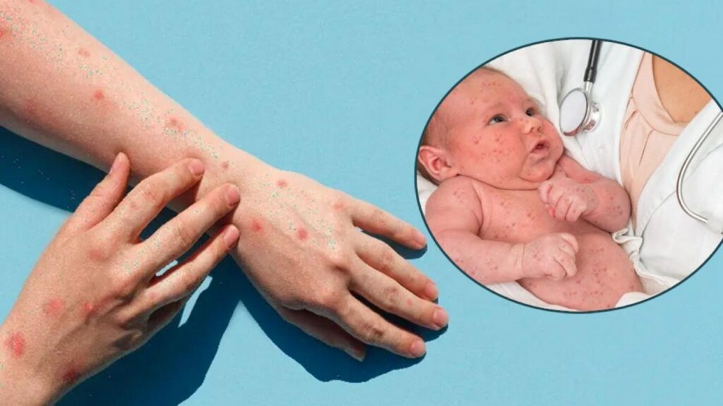 Kızamık krizi ebeveynlerin kaygılı düşü haline geldi: Aşısız çocuklar risk altında!