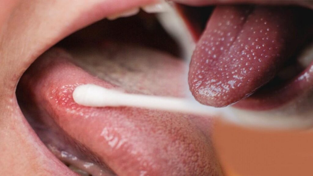 Lisanda neden uçuk çıkar ve ve geçirmek için ne yapmalı?