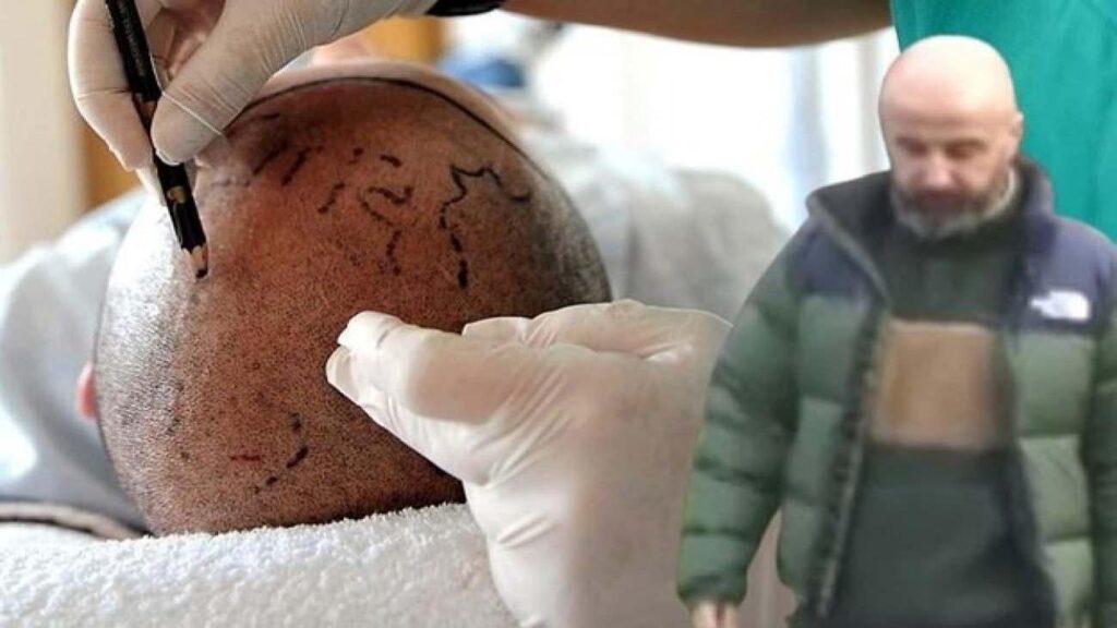 Saç ektirmeye giden adamın kulak zarı patladı! Şoke eden olay