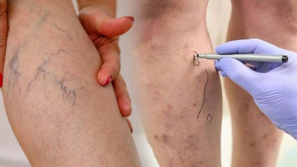 Varis deyip geçmeyin: Bacak sıhhatiniz alarm mı veriyor?