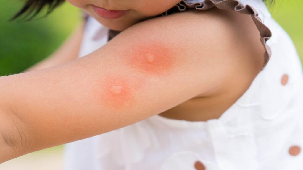 Bebek ve çocuklarda sivrisinek ısırıkları: Tedavisi ve tedbire yolları
