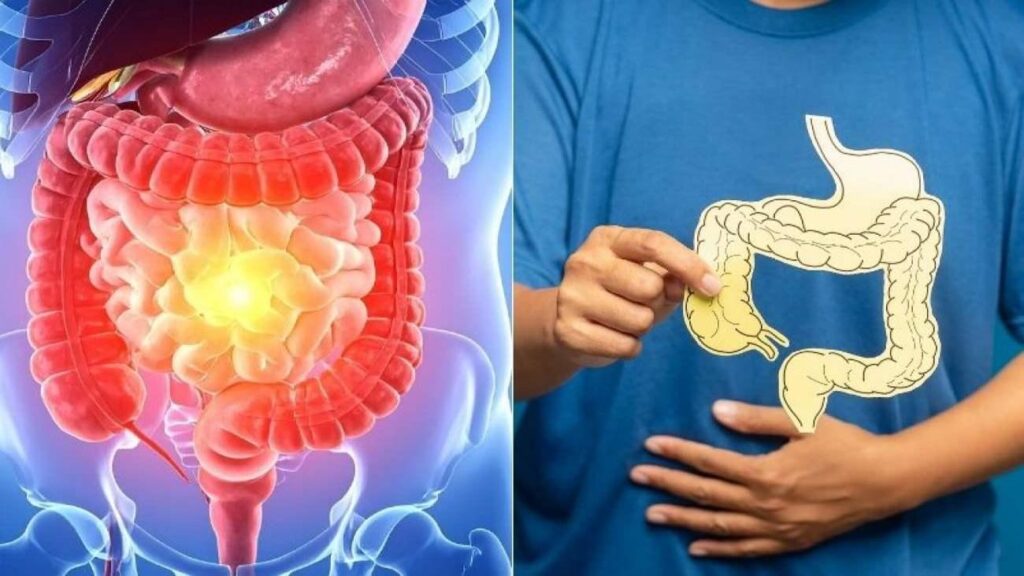 Gençler ortasında kolon kanseri alarm veriyor: Araştırma ortaya koydu