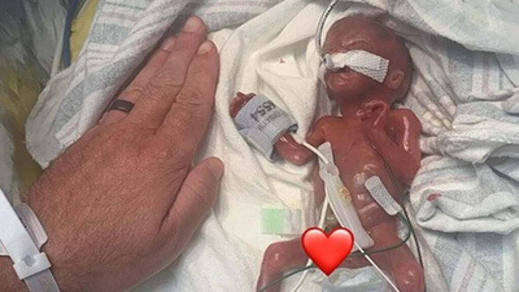 Hekimler ‘yaşamaz’ demişti! 280 gram doğan bebekten dünya rekoru