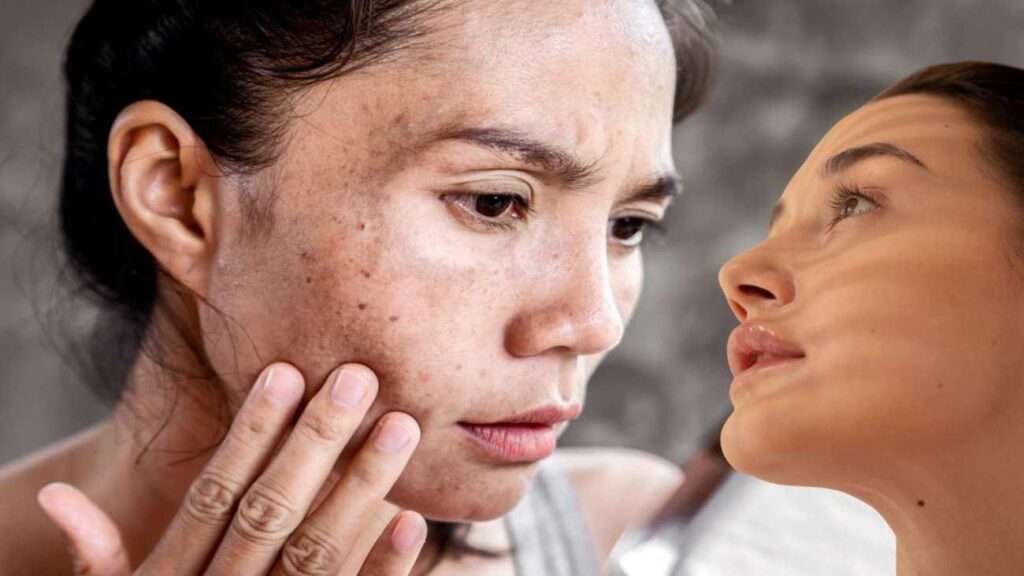 Tatil sonrası güneş lekeleri için ne yapmalı? Tesirli cilt maskeleri