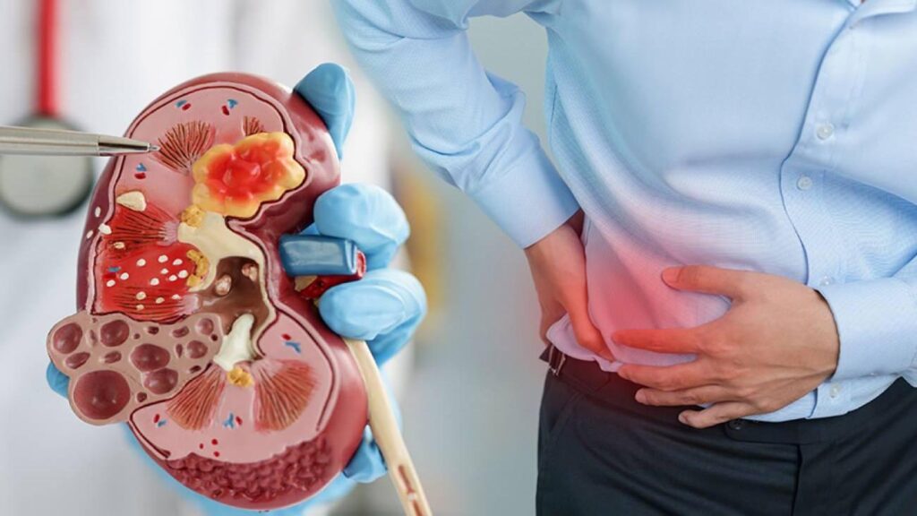 Uzman isimden dikkat çeken ikaz: Sıcak havalar böbrek taşı riskini tepeye taşıyor