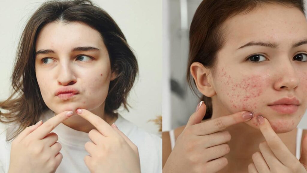Uzmanlardan ikaz: Akne izlerinde erken ve yanlışsız müdahale kaide