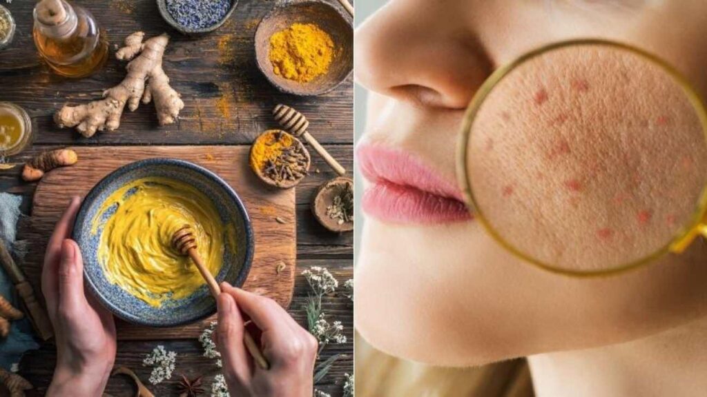 Zerdeçal ve bal maskesiyle aknelere savaş açın!