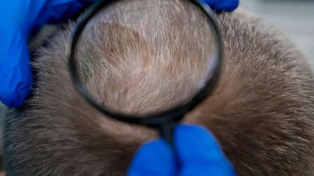 Erkek tipi saç dökülmesinde çığır açan adım: Clascoterone!