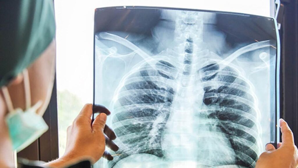 Tekrarlayan zatürreyi hafife almayın: Kanser belirtisi olabilir!