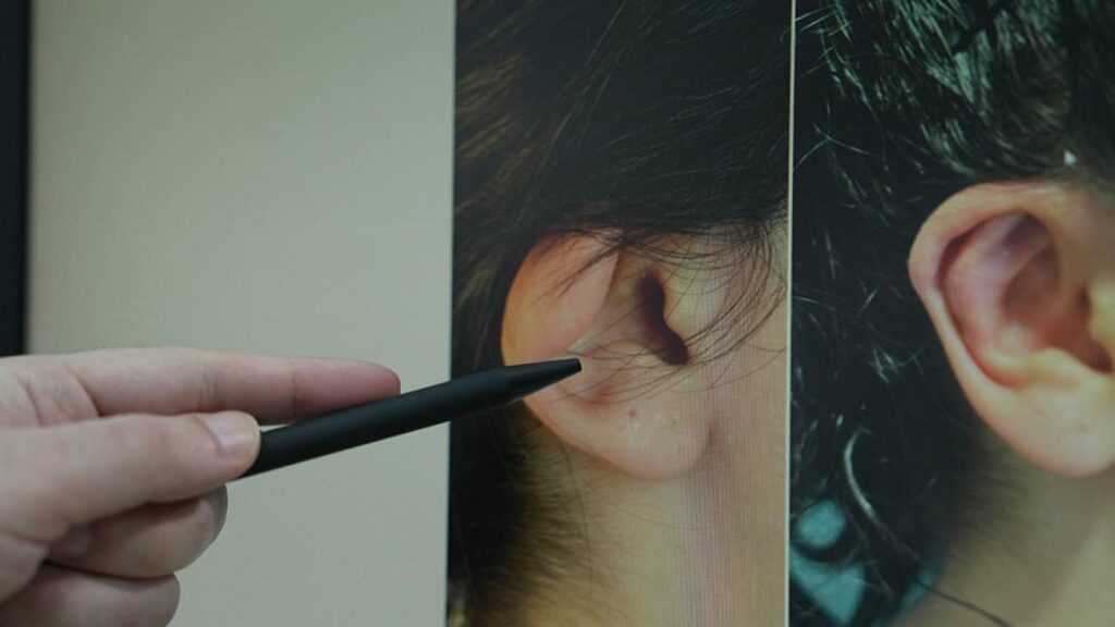 Uzman isim aileleri uyardı: Kepçe kulak özgüven kaybına yol açabiliyor