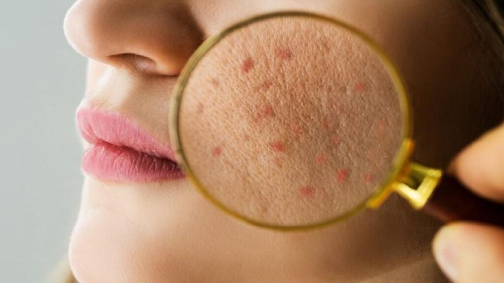 Yetişkinlerde akne alarmı: Uzman isim tetikleyen faktörleri sıraladı